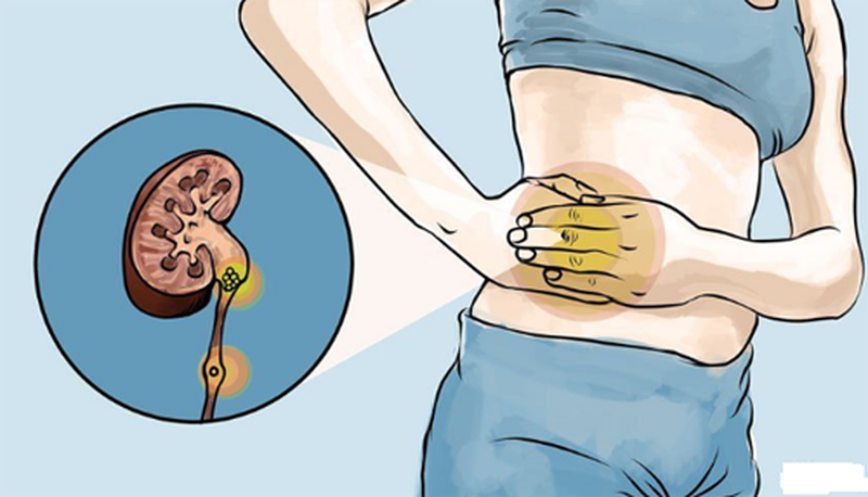 Bật mí cách điều trị sỏi thận xuống đường tiết niệu hiệu quả 1