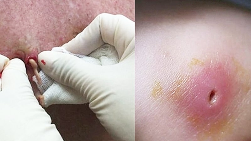 Cách nặn mụn nhọt ở mông tại nhà