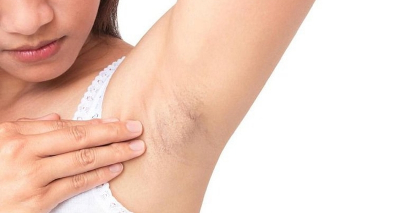 Nếu bạn bị mụn viêm ở vùng da dưới cánh tay, hãy nhổ lông tại thời điểm khác