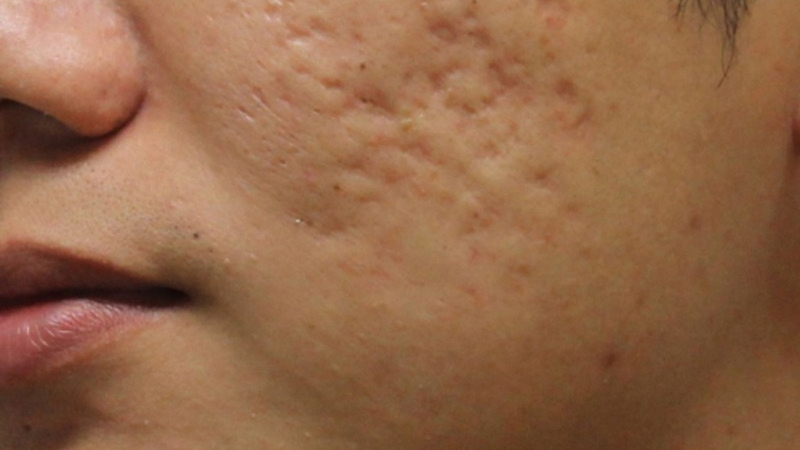 Bật mí cách trị sẹo rỗ bằng dầu dừa hiệu quả 3