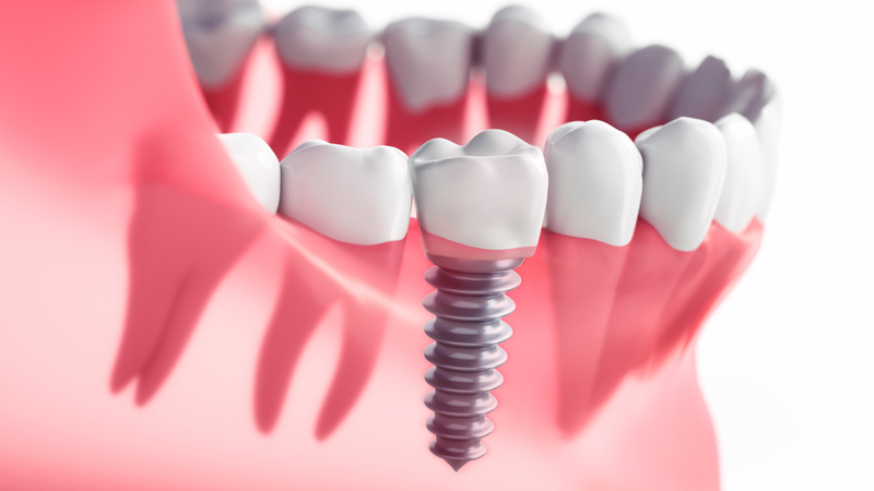 Bật mí kinh nghiệm trồng răng implant bạn nên biết 1