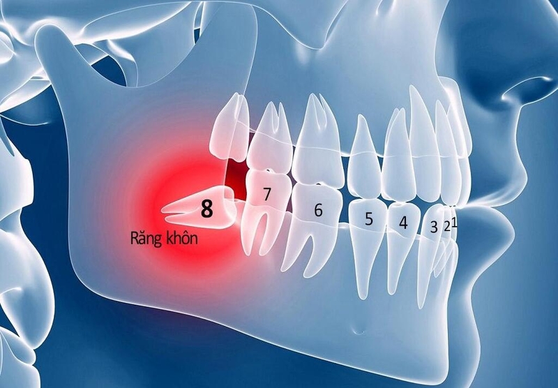 Bật mí một số phương pháp chỉnh răng mọc lệch không cần niềng 1