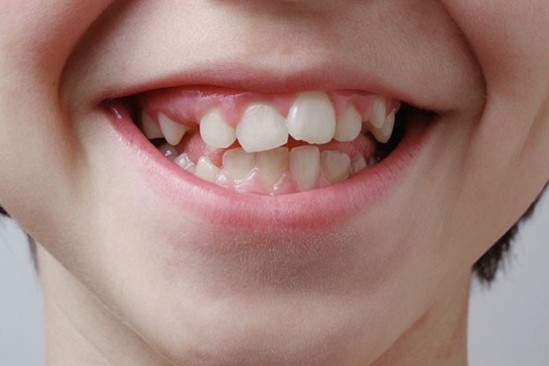 Bật mí một số phương pháp chỉnh răng mọc lệch không cần niềng 2