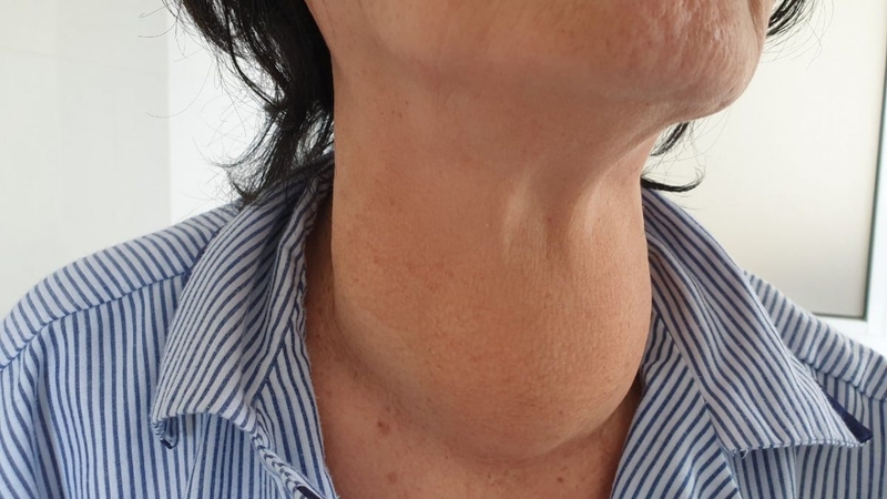 Bật mí những cây thuốc Nam chữa bệnh bướu cổ an toàn và hiệu quả 1