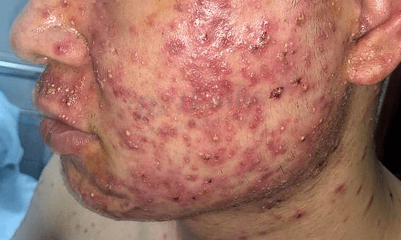 Cách trị mụn nội tiết ở nam hiệu quả 1