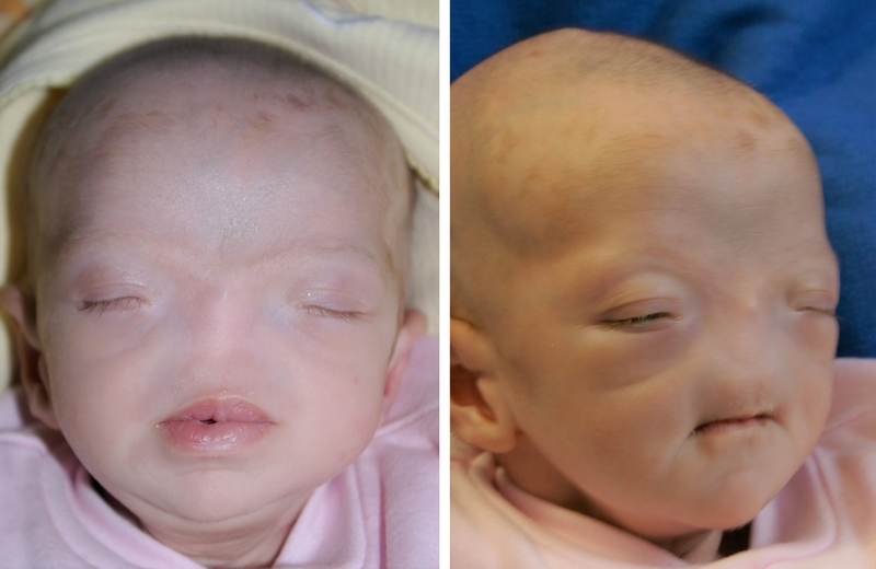 Bất sản xương mũi: Nguyên nhân, triệu chứng và cách điều trị hiệu quả 2