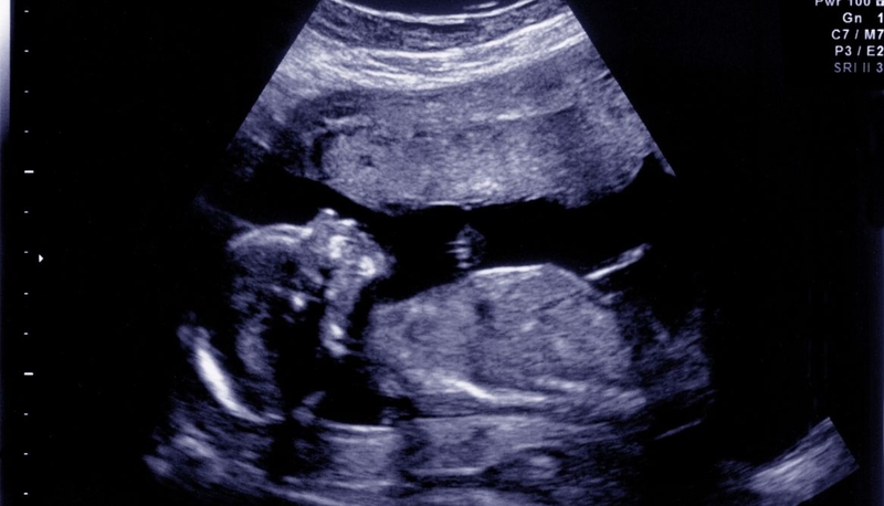 Bất sản xương mũi: Nguyên nhân, triệu chứng và cách điều trị hiệu quả 3