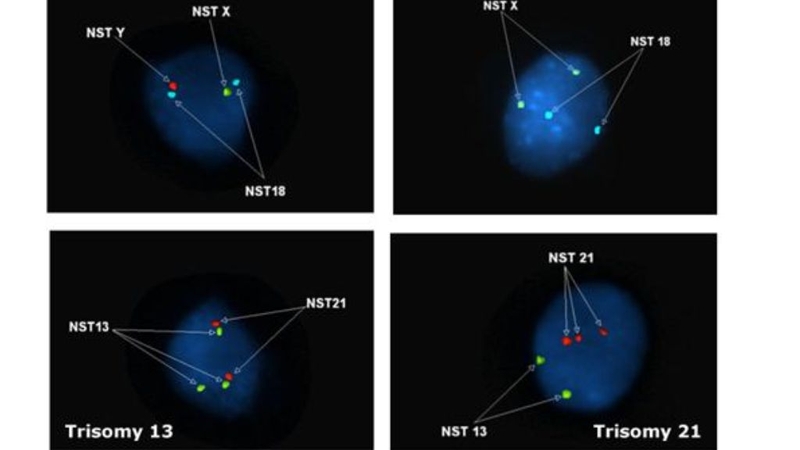 Bất thường nhiễm sắc thể số 16 gây ra bệnh gì? 3