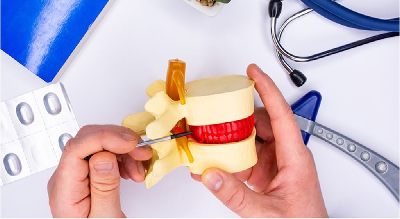 Bắt vít cột sống qua ống nong là thế nào? Quy trình thực hiện kỹ thuật ra sao? 2