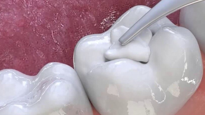 Bầu có trám răng được không? Có ảnh hưởng đến thai nhi không? 3