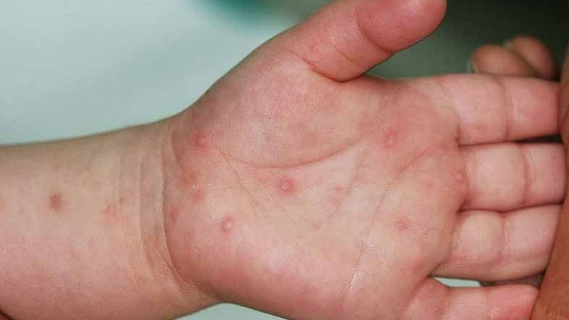 Cách điều trị bệnh tay chân miệng 2