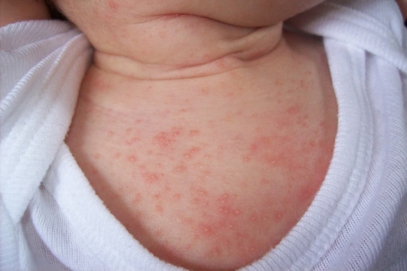 Bé 3 tuổi bị nổi mụn đầu trắng: Nguyên nhân và cách khắc phục 2