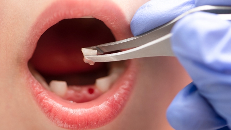 Bé 4 tuổi có nhổ răng được không&nbsp;là thắc mắc của nhiều bậc phụ huynh
