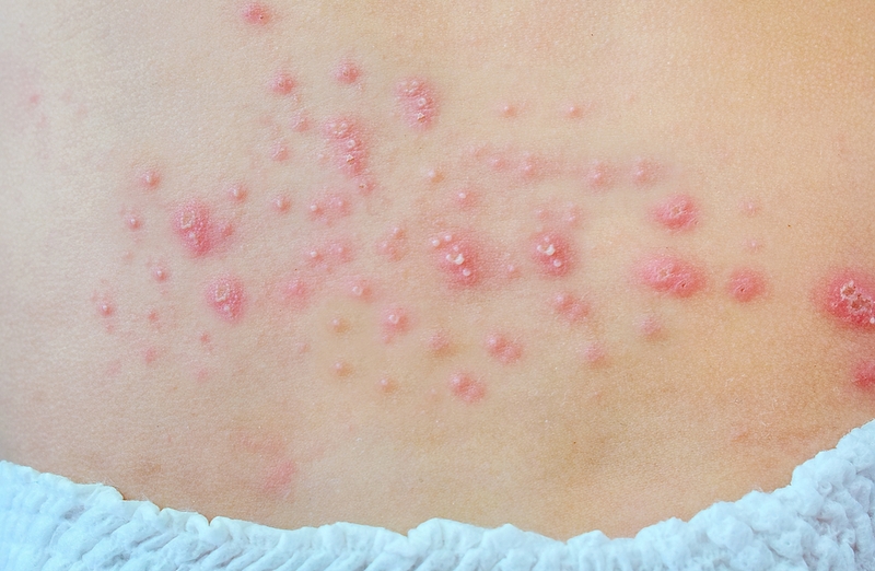 Dấu hiệu nhận biết bé bị hăm ở cổ