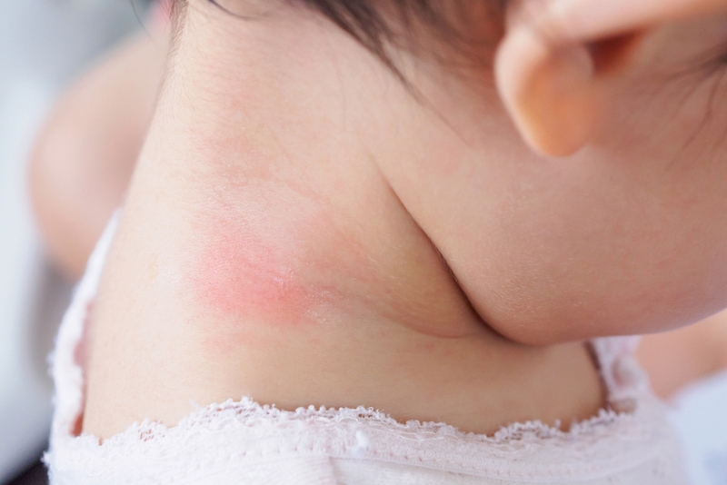 Có nhiều nguyên nhân khiến bé bị hăm cổ