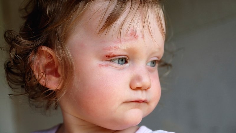 Bé bị lông quặm bẩm sinh phải làm sao? 2