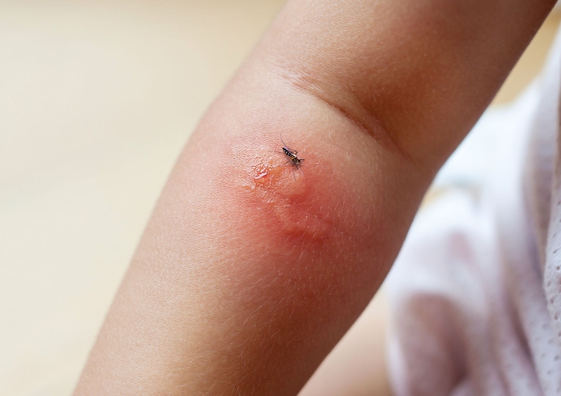 Bé bị muỗi đốt dễ dàng nhận biết qua biểu hiện ngoài da