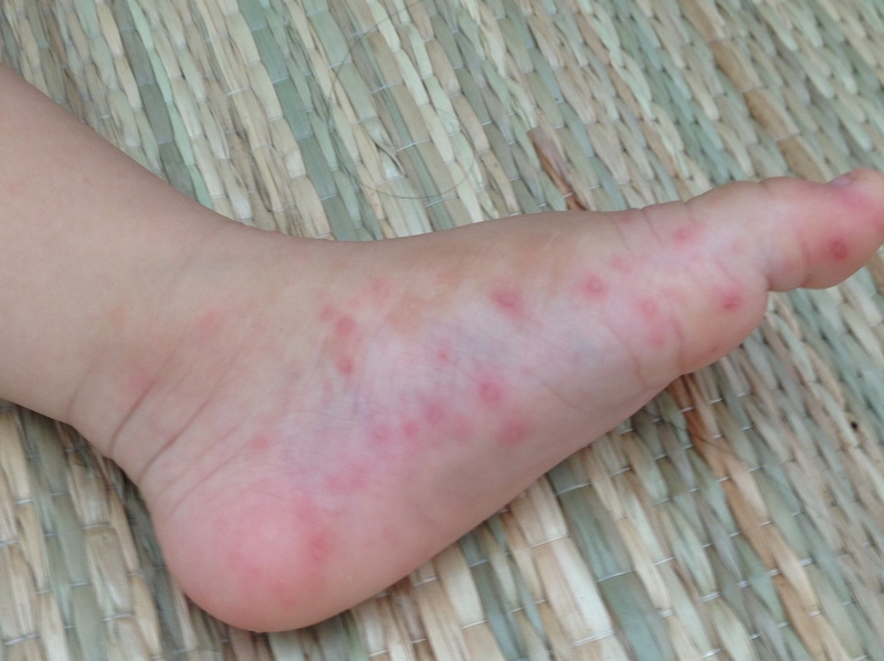 Bé bị tay chân miệng không sốt có tắm được không 3