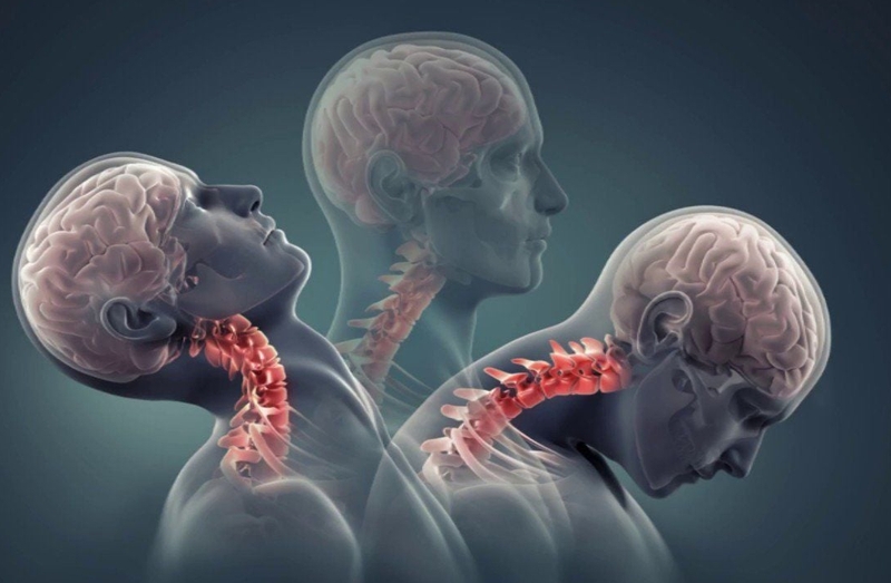 Bẻ cổ kêu răng rắc có phải bệnh lý nguy hiểm không? 3