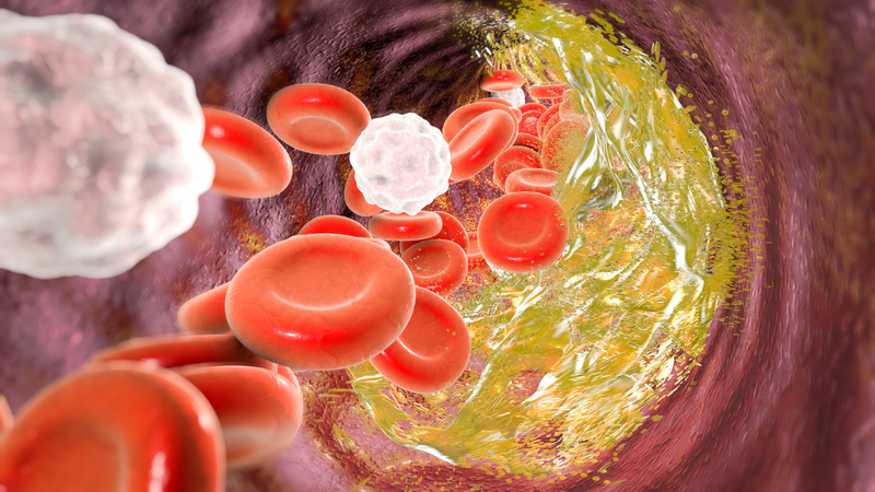 Bempedoic Acid hỗ trợ làm giảm Cholesterol LDL 2