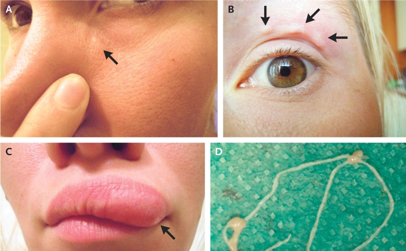Bệnh Dirofilariasis là gì? Những vấn đề cần biết về Bệnh Dirofilariasis ở người1.jpg