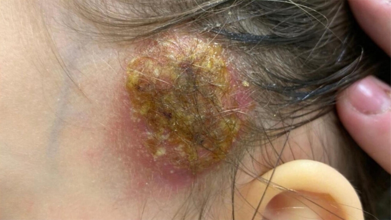 Bệnh Kerion De Celse ở trẻ em: Nhận biết sớm và điều trị kịp thời tránh biến chứng 0