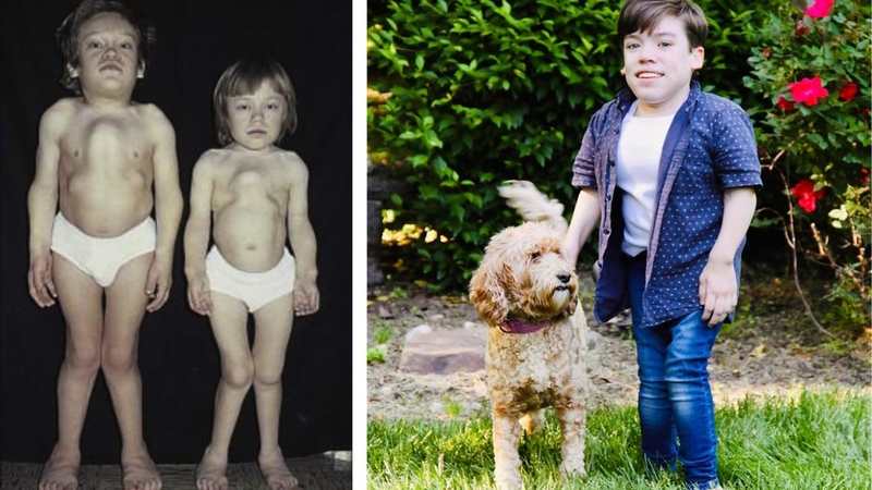 Hiểu đúng và đủ về bệnh Morquio - Rối loạn chuyển hóa di truyền hiếm gặp 1