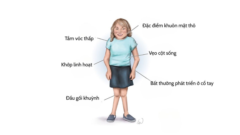 Hiểu đúng và đủ về bệnh Morquio - Rối loạn chuyển hóa di truyền hiếm gặp 3