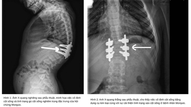 Hiểu đúng và đủ về bệnh Morquio - Rối loạn chuyển hóa di truyền hiếm gặp 5