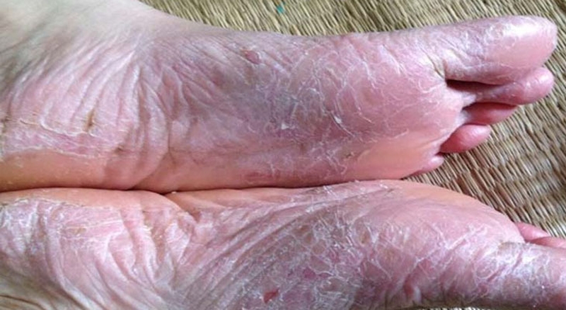 Bệnh á sừng ở chân: Nguyên nhân, dấu hiệu và cách cải thiện hiệu quả 1