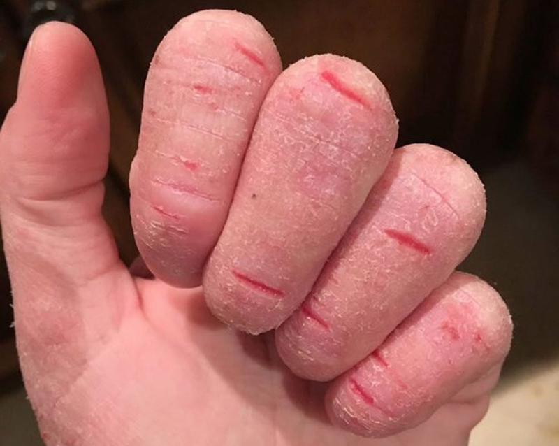 Bệnh á sừng ở tay: Mẹo chữa trị hiệu quả bằng phương pháp dân gian 2