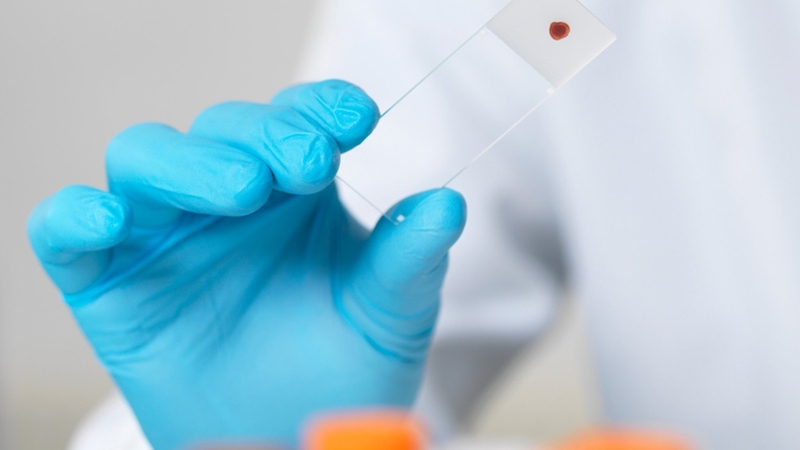 Bệnh Agglutinins lạnh là gì? Nguyên nhân, triệu chứng và cách điều trị bệnh 2