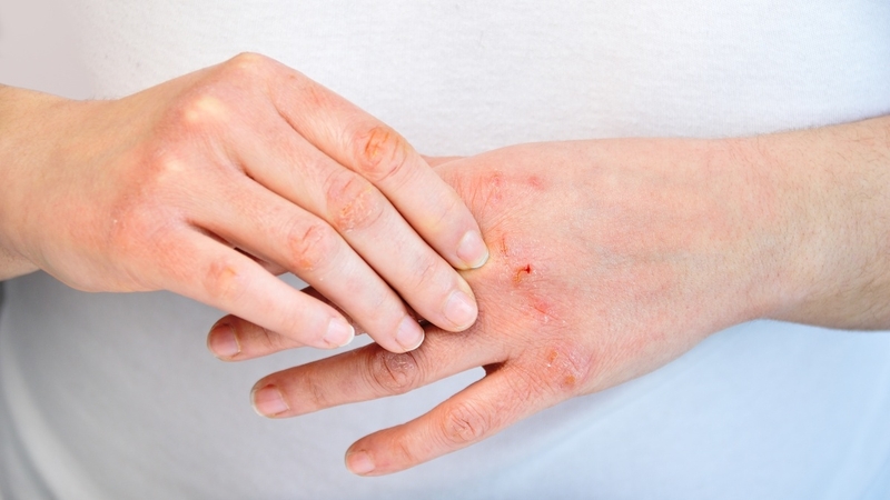 Bệnh Atopy là gì? Đây là căn bệnh viêm da cơ địa liên quan đến rối loạn miễn dịch