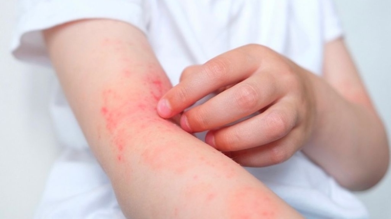 Dị ứng là một trong những nguyên nhân gây bệnh