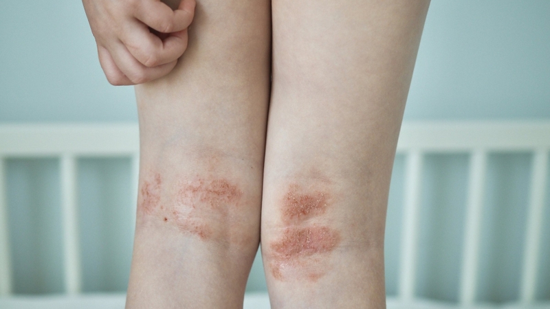 Tổn thương của bệnh Atopy ở nhiều vùng da khác nhau