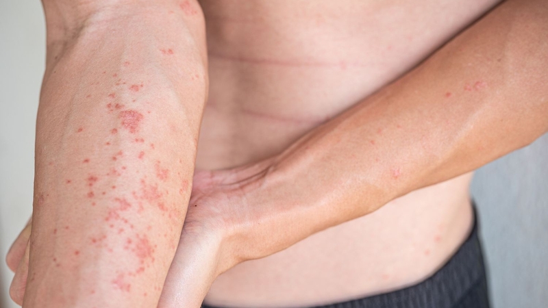 Người mắc bệnh Atopy thường xuyên bị mất ngủ do các cơn ngứa trên da