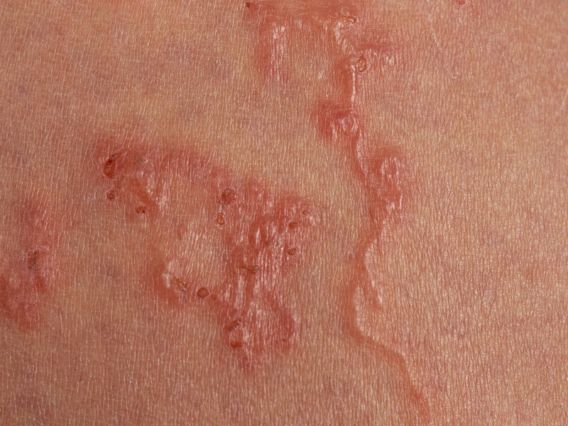 Bệnh ấu trùng da di chuyển: Nguyên nhân, triệu chứng, phương pháp điều trị 4