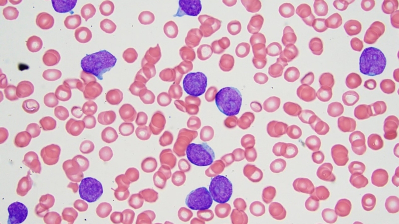 Bệnh bạch cầu lymphoblastic cấp tính và những điều bạn cần biết 2