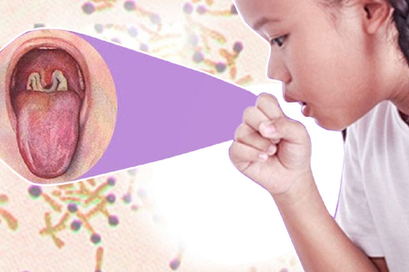 Bệnh bạch hầu có tái phát không? Những biện pháp phòng tránh bệnh bạch hầu 2