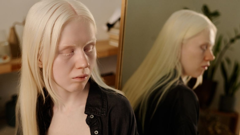 Nhiều người bệnh muốn biết&nbsp;bệnh bạch tạng có sinh con được không