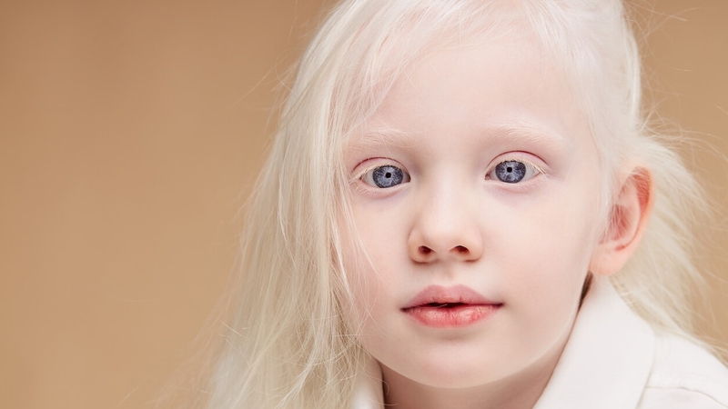 Bệnh bạch tạng là đột biến gì? Dấu hiệu nhận biết và cách điều trị bệnh 1