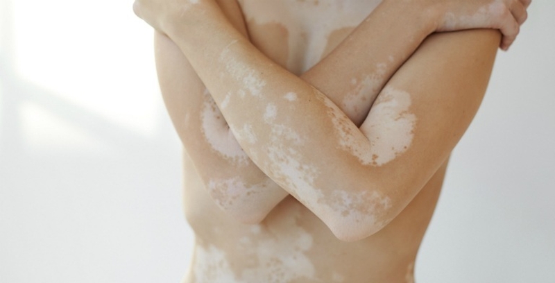 Bệnh bạch tạng sống được bao lâu? Nguyên nhân dẫn đến bệnh bạch tạng 2