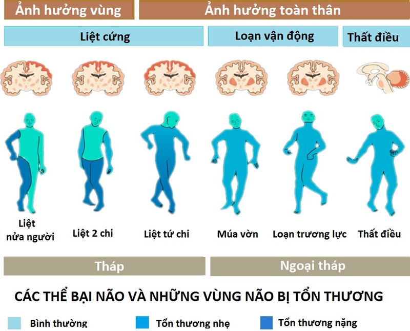 Bệnh bại não có thể phát hiện khi mang thai không? Cách phòng ngừa bệnh bại não khi mang thai 1