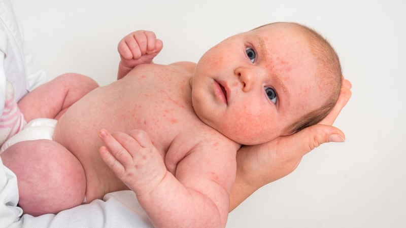 Bệnh ban đào: Nguyên nhân, triệu chứng, cách điều trị 2