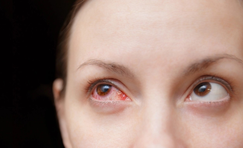 Bệnh Behcet là bệnh gì? Cách chẩn đoán và điều trị bệnh Behcet 2