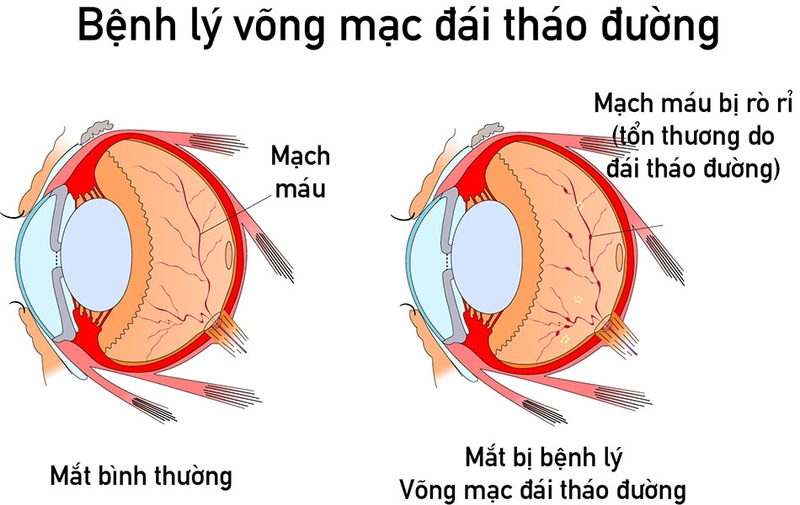 Bệnh bong võng mạc đái tháo đường và những điều cần biết 1