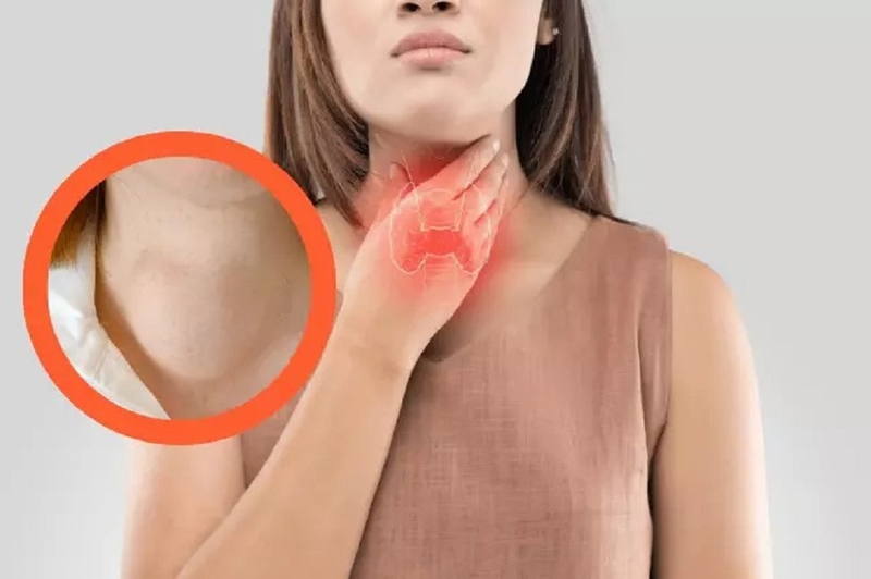 Bệnh bướu cổ lây qua đường nào? Có điều trị được không? 2