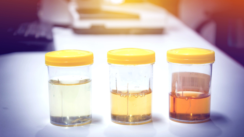 Bệnh cầu thận là gì? Nguyên nhân, triệu chứng và cách điều trị 4