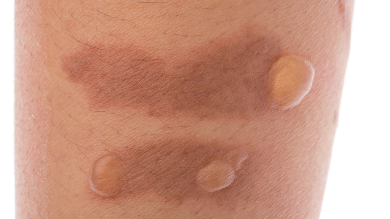 Bệnh chốc lở ở trẻ em có lây không và biện pháp phòng bệnh hiệu quả 2