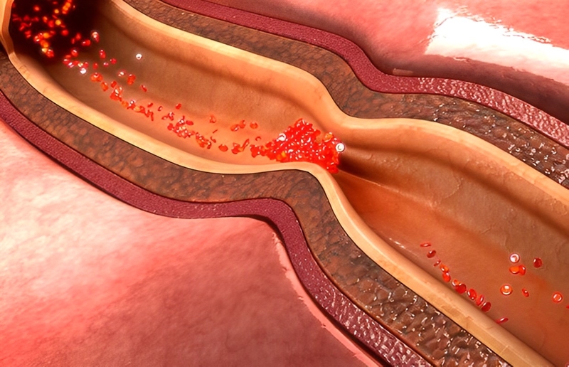 Bệnh co thắt mạch vành tim: Định nghĩa, chẩn đoán và cách điều trị 1